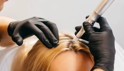 microneedling-and-prp-treatment-for-hair-loss